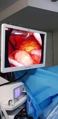 لایو اینستاگرام : جراحی چاقی بای پس کلاسیک در آقای 38 ساله