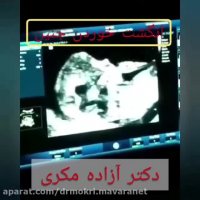 انگشت خوردن شکم در داخل شکم مادر